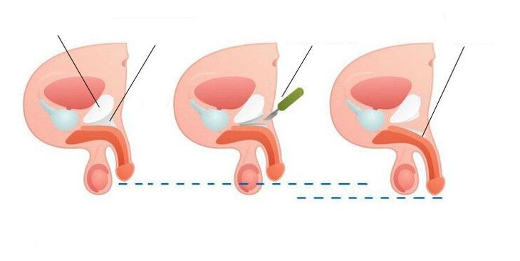 Penisvergrößerung nach Operation